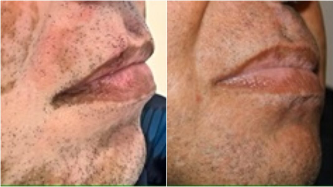 Após divórcio, homem recupera pigmentação de pele perdida por vitiligo (Foto: Instagram)