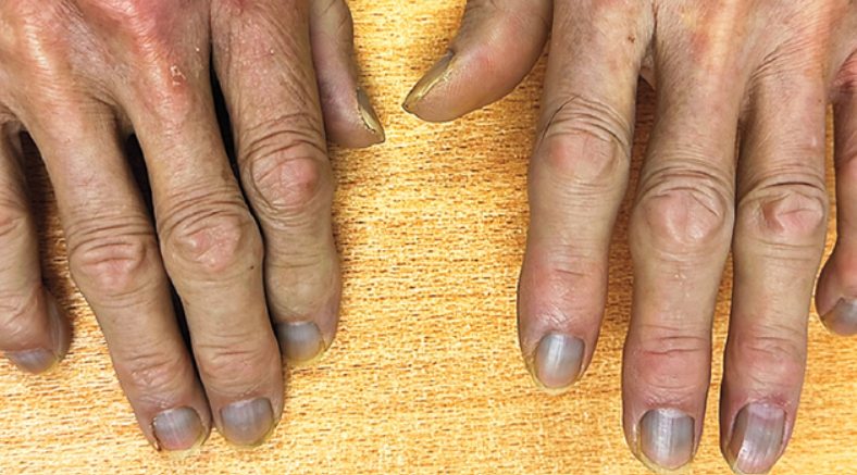 Um homem de 84 anos, residente de Hong Kong, apresentou uma coloração acinzentada na pele causada por altos níveis de prata acumulados no organismo, uma condição rara conhecida como argiria (Foto: X)