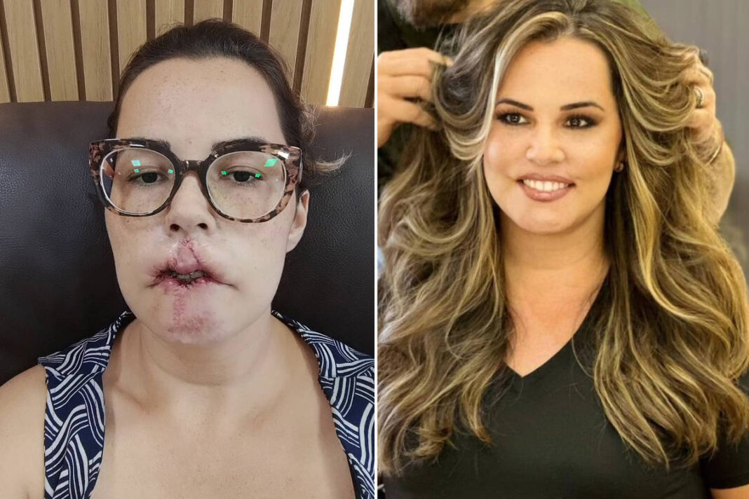 Mariana Michelini, 36 anos, concluiu uma série de cinco cirurgias para reconstrução dos lábios após complicações graves decorrentes do uso de PMMA (polimetilmetacrilato) em um procedimento estético (Foto: Instagram)
