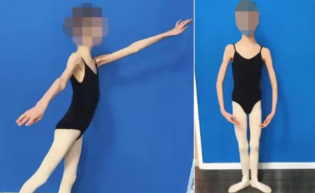 Em um caso que chocou a Austrália, um casal foi condenado após a filha, uma jovem bailarina, ser encontrada pesando apenas 27 quilos, em estado de desnutrição extrema (Foto; Instagram)