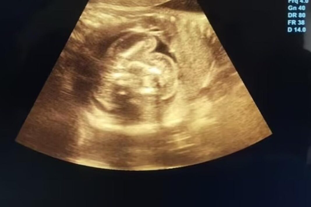 Uma gestante de 32 anos, na Índia, recebeu uma notícia inesperada durante a 35ª semana de gravidez: exames indicaram que o bebê carregava dois fetos dentro do próprio abdômen (Foto: X)