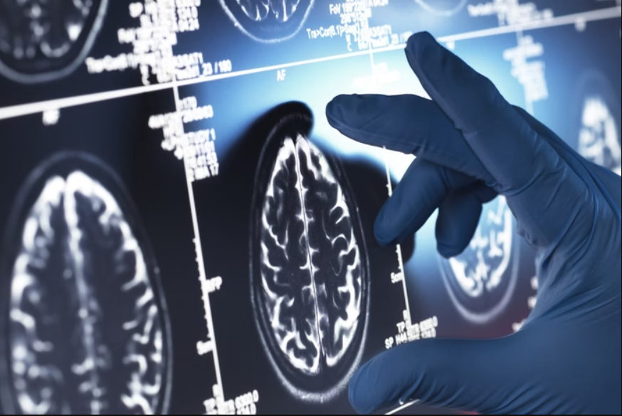 Pela primeira vez, o Brasil conta com um medicamento aprovado especificamente para tratar os estágios iniciais do Alzheimer (Foto: Unsplash)