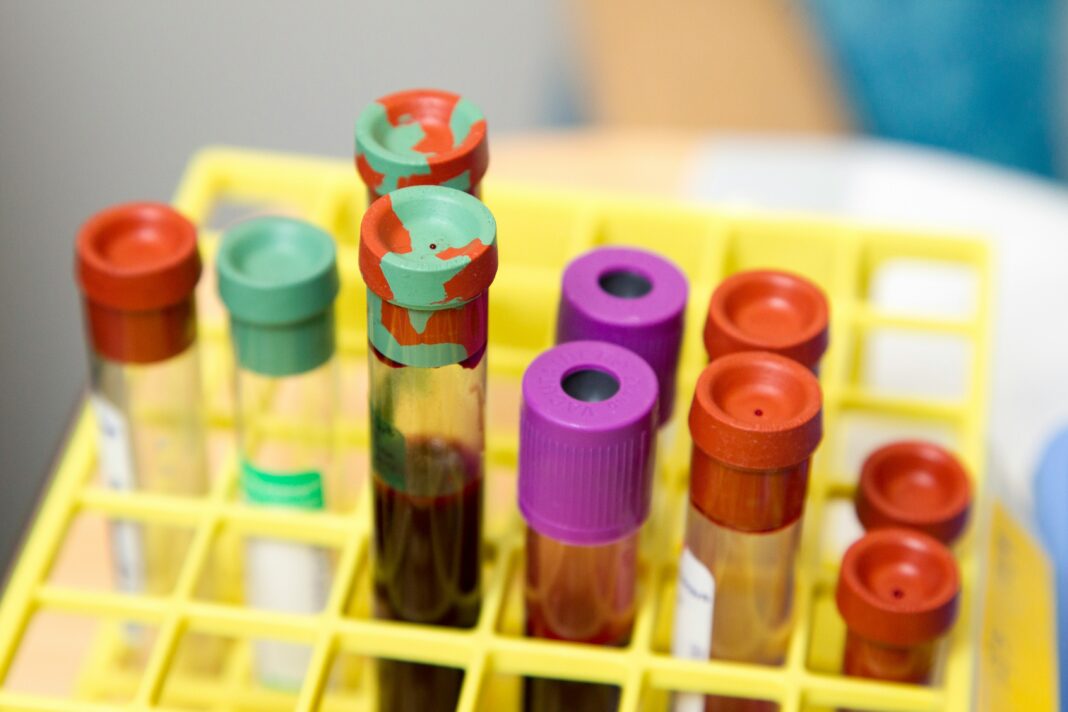 Uma equipe de cientistas da Universidade Hebraica de Jerusalém desenvolveu um teste de sangue capaz de identificar a doença de Parkinson antes mesmo do surgimento dos primeiros sinais clínicos (Foto: Unsplash)