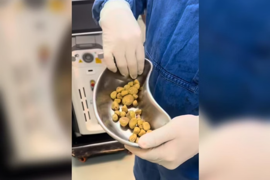 De acordo com o especialista, bebidas desse tipo são ricas em ácido fosfórico e açúcares — compostos que aumentam significativamente o risco de formação de pedras nos rins e na bexiga (Foto: X)