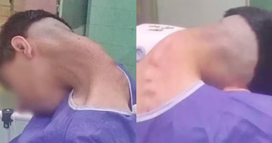 Um caso raro registrado no Irã chamou a atenção da comunidade médica: um jovem desenvolveu a chamada “síndrome da cabeça caída” após anos de uso de drogas como anfetaminas, heroína e ópio (Foto: X)