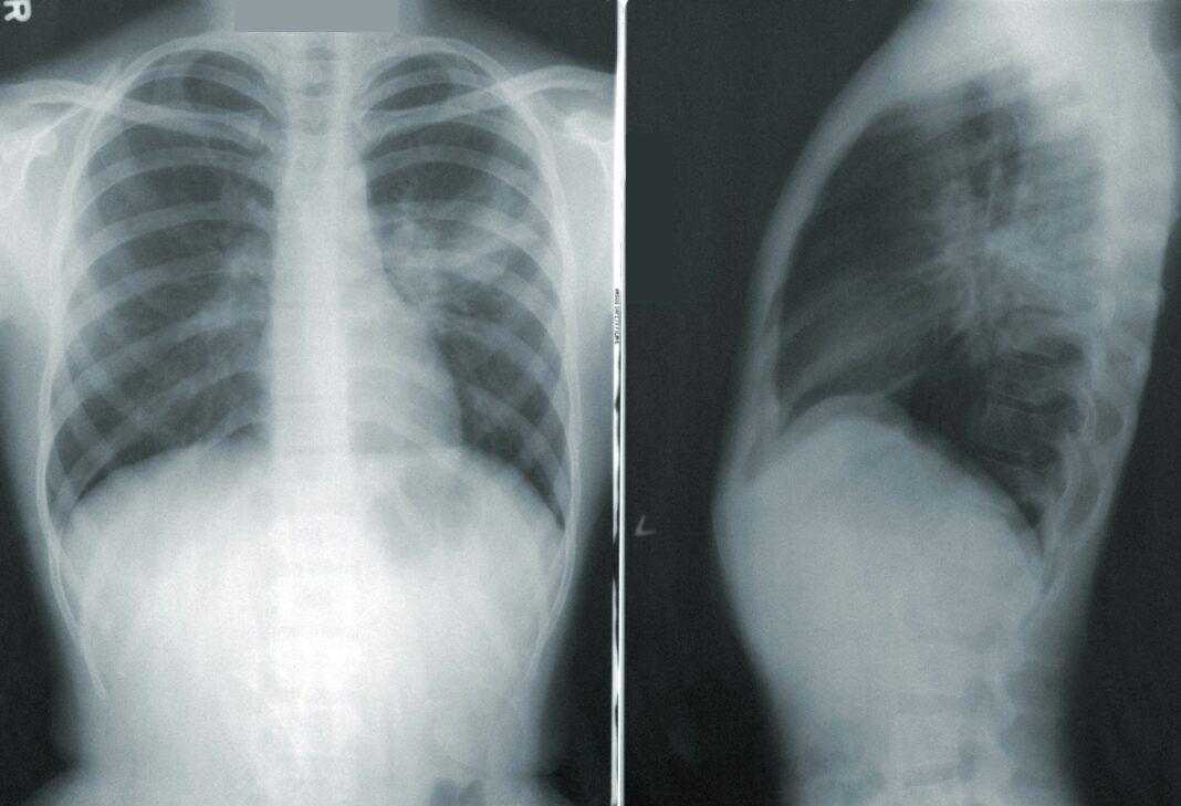 Embora não seja uma doença de notificação obrigatória no Brasil, a pneumonia voltou a acender um alerta no sistema público de saúde (Foto: Unsplash)