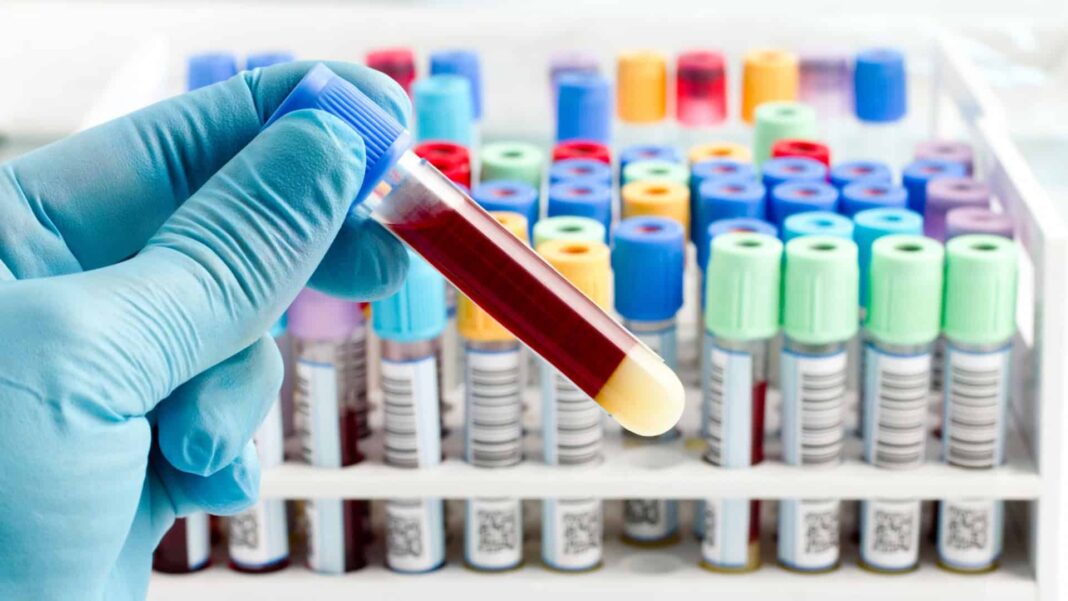 Uma nova pesquisa genética sugere que o tipo sanguíneo pode influenciar o risco de sofrer um acidente vascular cerebral (AVC) antes dos 60 anos (Foto: X)