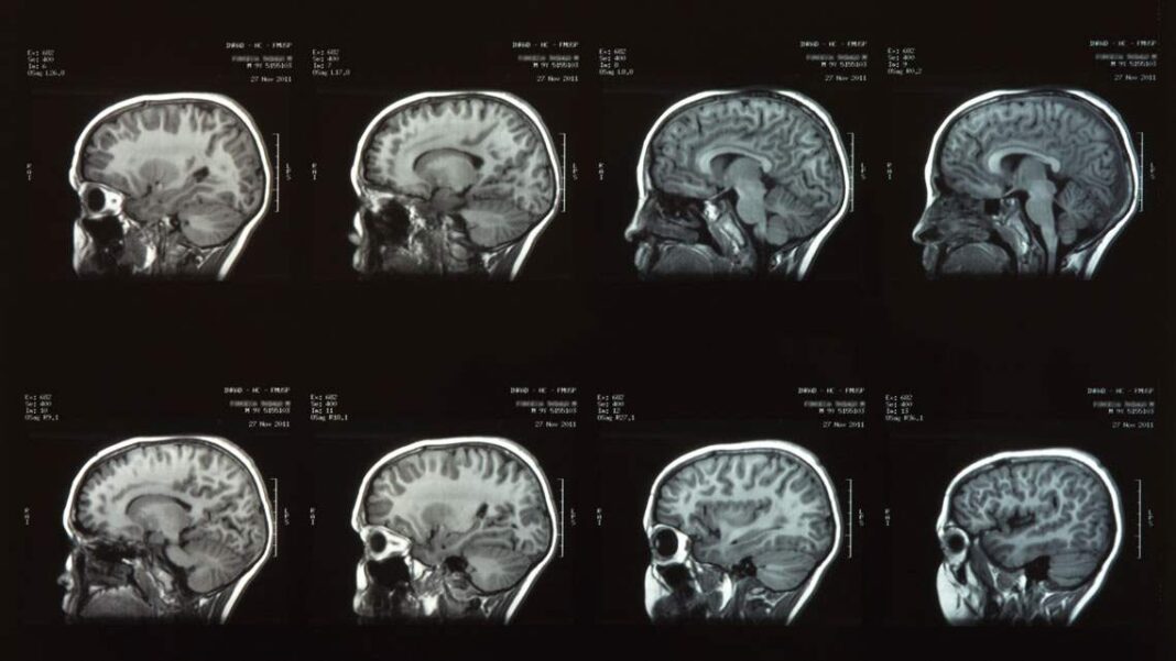 A pesquisa, publicada na Nature Aging em 1º de julho, revela que, por meio da análise de imagens cerebrais, é possível estimar como o envelhecimento biológico de uma pessoa está avançando, e até antecipar a ocorrência de problemas de saúde (Foto: X)