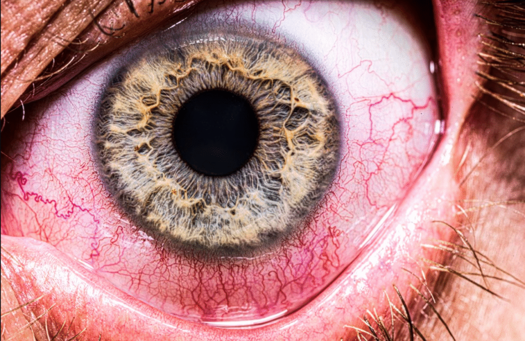 Um caso raro registrado na Índia chamou atenção da comunidade médica: um homem de 35 anos descobriu que a causa de sua visão embaçada e inflamação ocular persistente era um verme vivo dentro do olho (Foto: X)