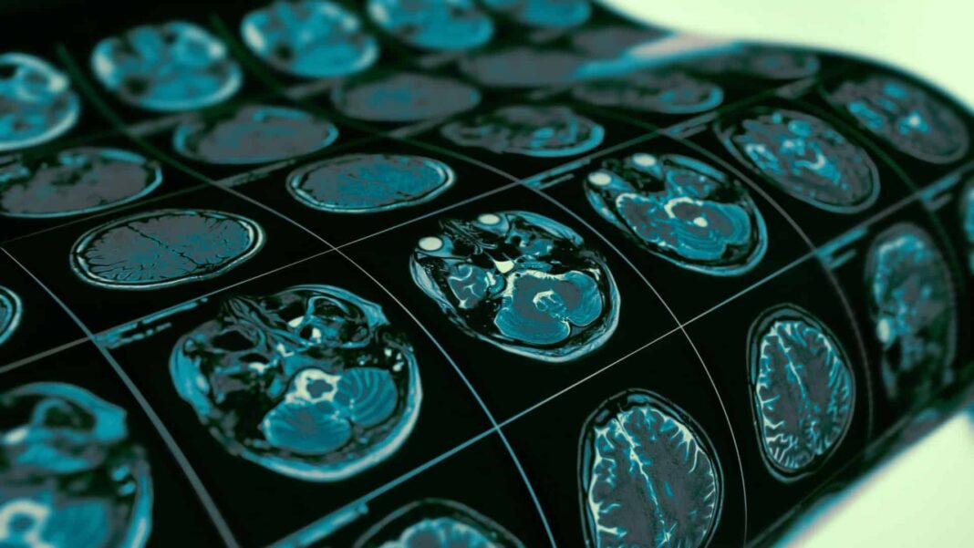 Mudanças genéticas que ajudaram os seres humanos a desenvolver linguagem e pensamento complexo podem também ter aumentado a predisposição a transtornos como o autismo (Foto: Unsplash)