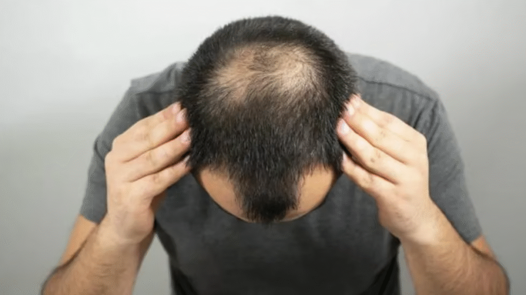 De acordo com os pesquisadores, o esteviosídeo funciona como um agente de solubilização natural, permitindo que o minoxidil penetre melhor na pele e atinja os folículos capilares de forma mais eficiente (Foto: X)
