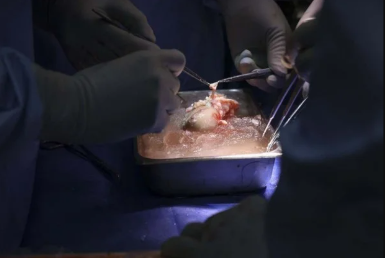 Pela primeira vez, uma equipe internacional de pesquisadores conseguiu reverter episódios de rejeição a um órgão suíno transplantado em um corpo humano (Foto: X)