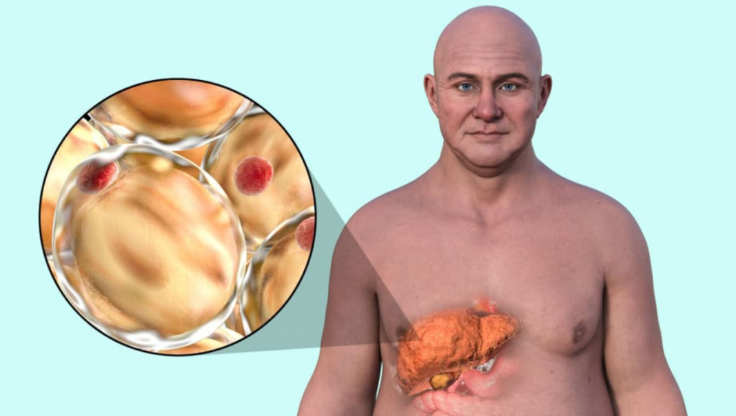 A gordura no fígado, conhecida clinicamente como esteatose hepática, costuma avançar de forma silenciosa e, na maioria dos casos, é descoberta por acaso, durante exames de rotina (Foto: X)