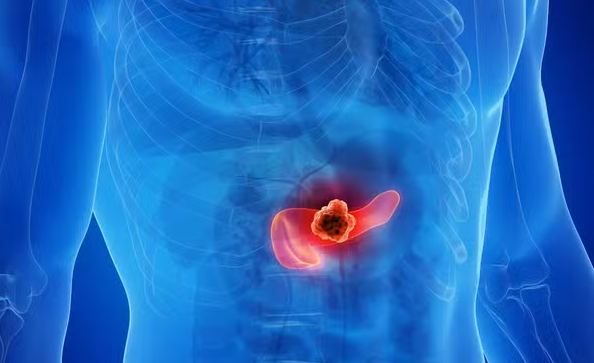 Uma estratégia inédita baseada na combinação de três medicamentos conseguiu eliminar completamente tumores de câncer de pâncreas em testes com animais, segundo pesquisa conduzida por cientistas da Espanha (Foto: X)
