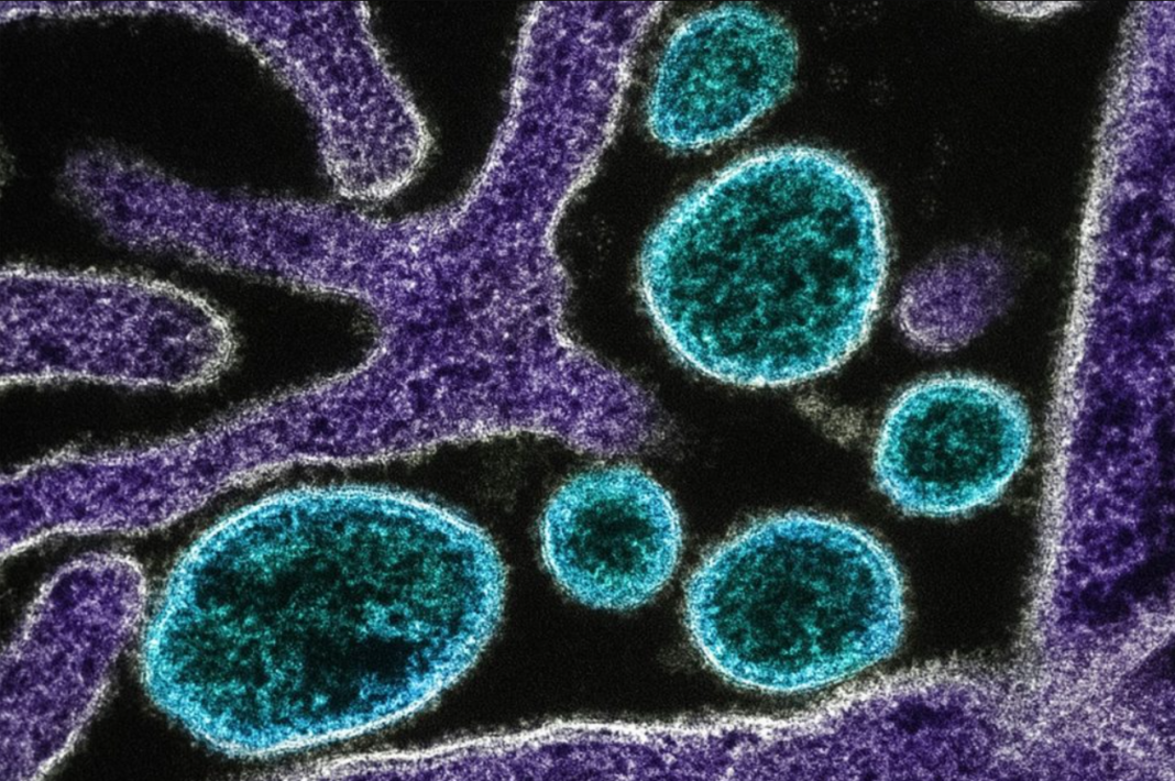 O surgimento recente de novos casos do vírus Nipah em países da Ásia reacendeu o debate sobre o potencial pandêmico da doença, conhecida pela alta taxa de letalidade (Foto: X)