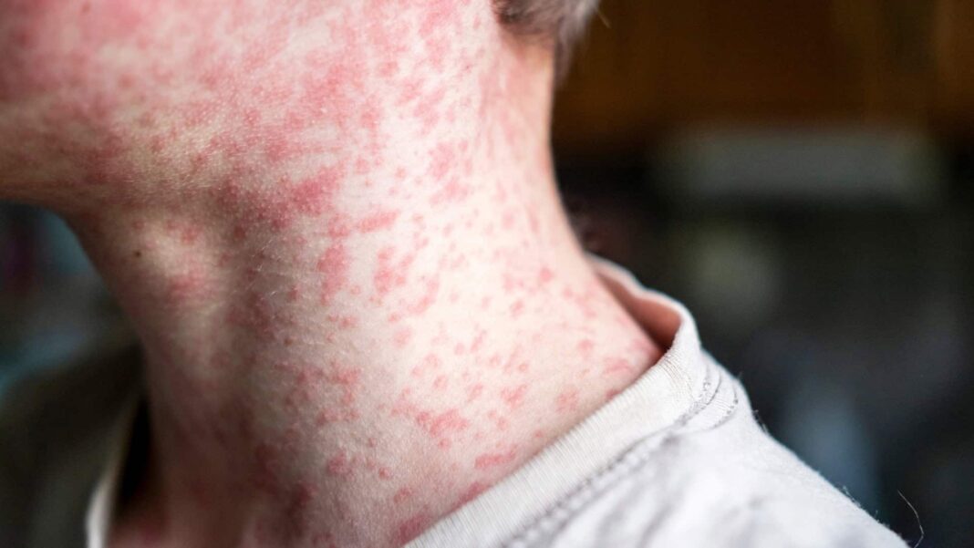 O crescimento acelerado dos casos de sarampo voltou a preocupar autoridades de saúde em diferentes países (Foto: X)