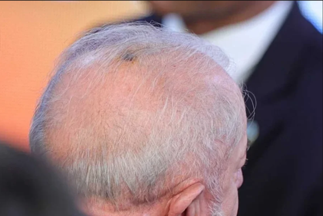 O presidente Luiz Inácio Lula da Silva passou por um procedimento dermatológico no último domingo (9) para retirada de uma lesão de queratose no couro cabeludo (Foto: X)