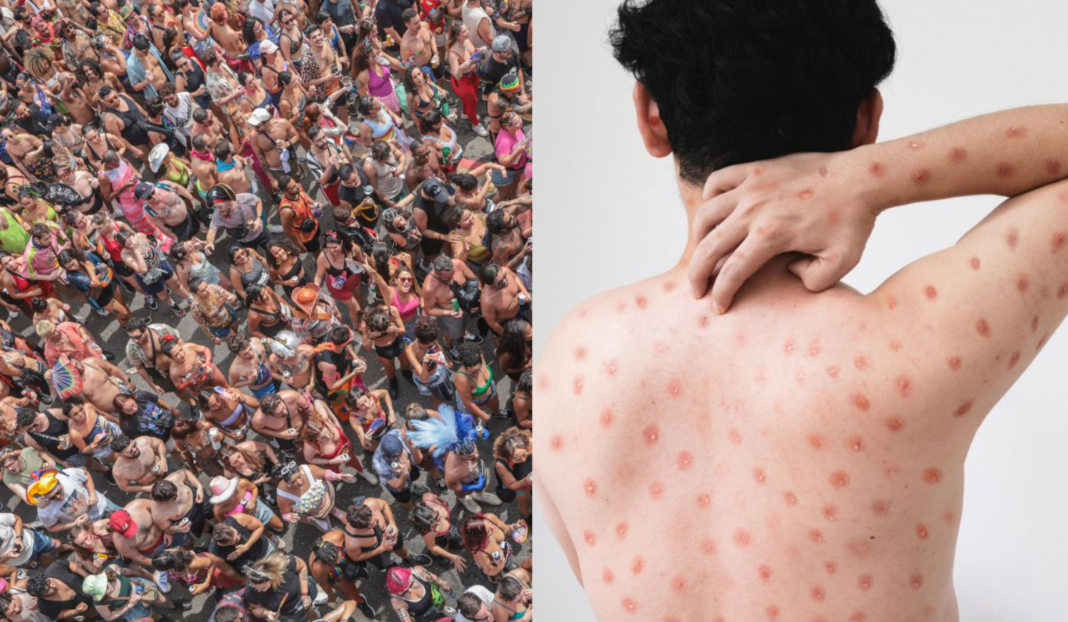 A Secretaria Municipal de Saúde de Porto Alegre confirmou o primeiro caso de Mpox na capital gaúcha em 2026 (Foto: X)