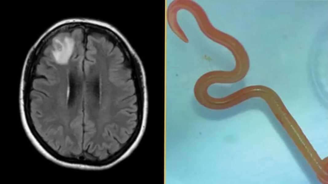 Uma infecção pulmonar que desafiou médicos por mais de um ano levou à identificação de um parasita nunca antes registrado em humanos (Foto: X)