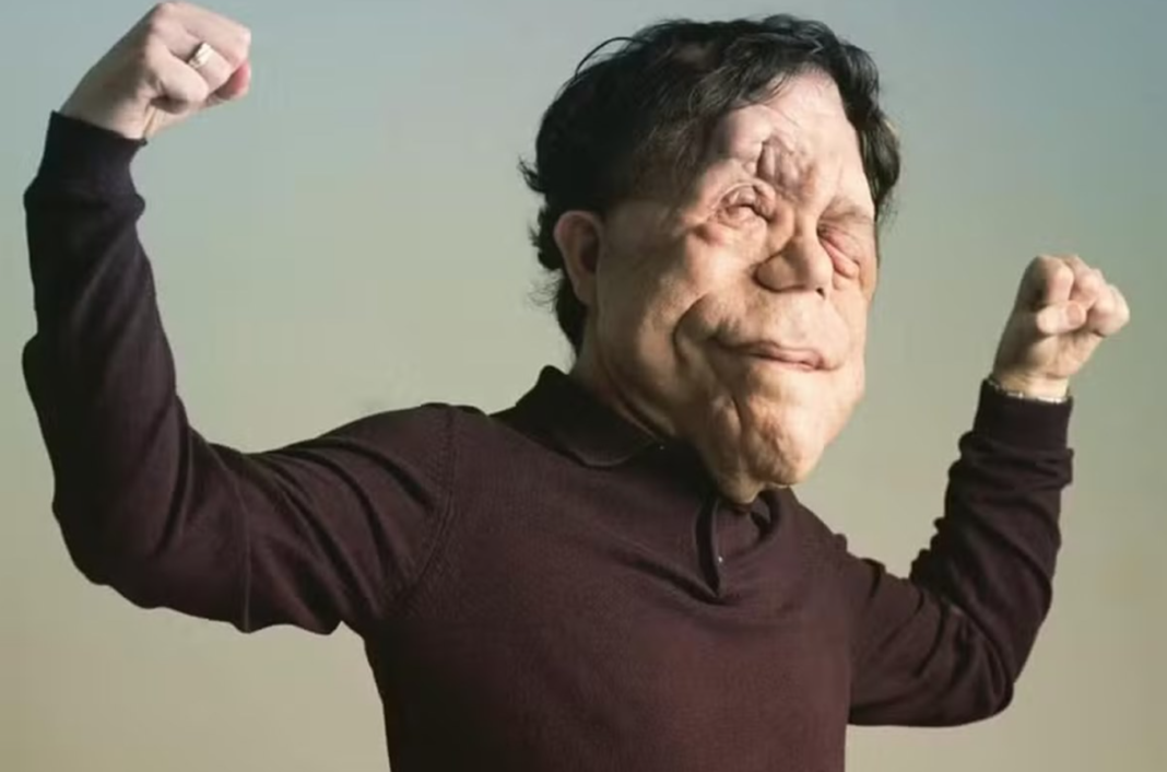 O ator britânico Adam Pearson, de 41 anos, voltou a chamar atenção do público ao marcar presença no tapete vermelho do Oscar, no último domingo (15) (Foto: X)