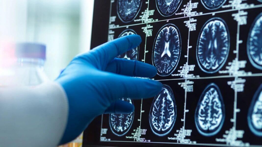 Pesquisadores dos Estados Unidos identificaram um mecanismo natural do cérebro que pode ajudar determinados neurônios a se protegerem do Alzheimer (Foto: X)