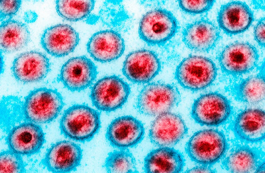 Um homem de 63 anos alcançou remissão do HIV após passar por um transplante de medula óssea com células do próprio irmão (Foto: X)