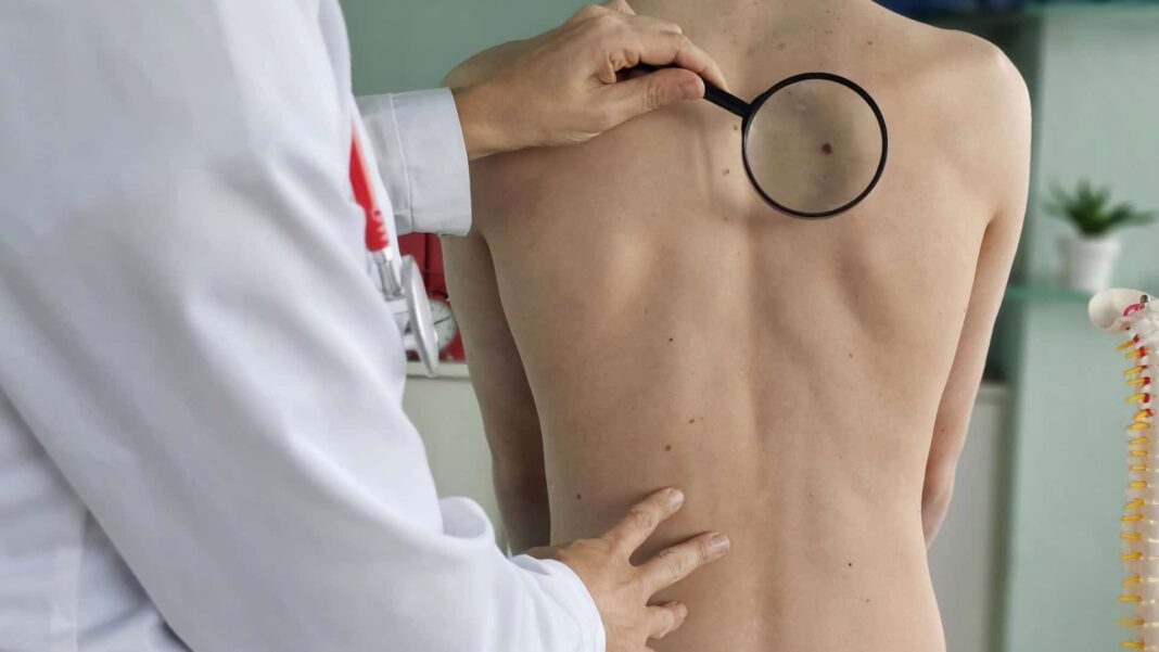 Um novo tratamento experimental contra o câncer de pele está em fase de testes clínicos no Brasil e pode representar uma alternativa menos invasiva às terapias tradicionais (Foto: X)